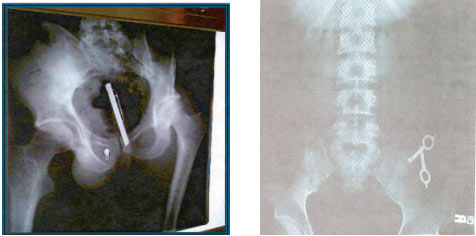 Photographs Showing Metal Contraband Detected Using Body Cavity X-Ray Technology